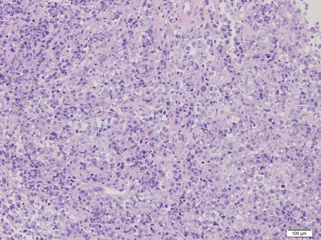 Anaplastic-Large-Cell-Lymphoma_1_Low-Power_co_Beatriz-Agredano