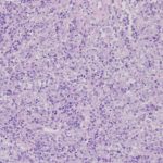 Anaplastic-Large-Cell-Lymphoma_1_Low-Power_co_Beatriz-Agredano