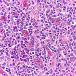 Angioimmunoblastic-T-Cell-Lymphoma