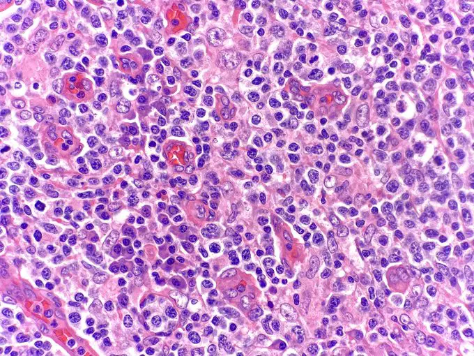 Angioimmunoblastic-T-Cell-Lymphoma