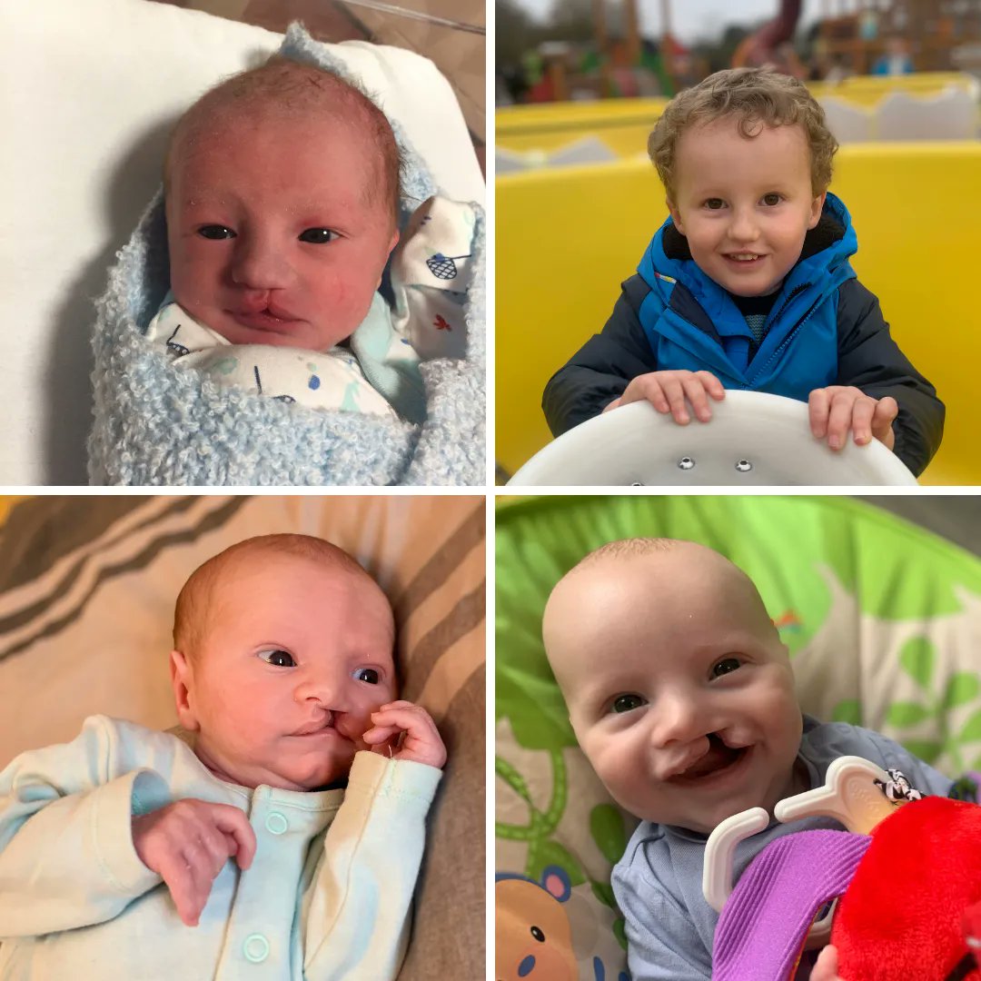 Cleft Lip and Cleft Palate Malformation