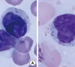 Large Granular Lymphocytic Leukemia