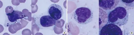 Large Granular Lymphocytic Leukemia