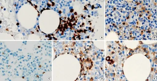 Large Granular Lymphocytic Leukemia_Immunohistochemistry