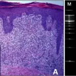 Mycosis-Fungoides