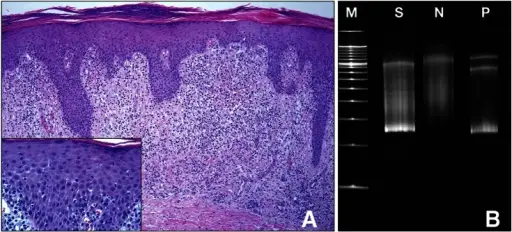 Mycosis-Fungoides