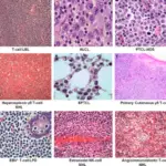 Peripheral T-Cell Neoplasms_Histology