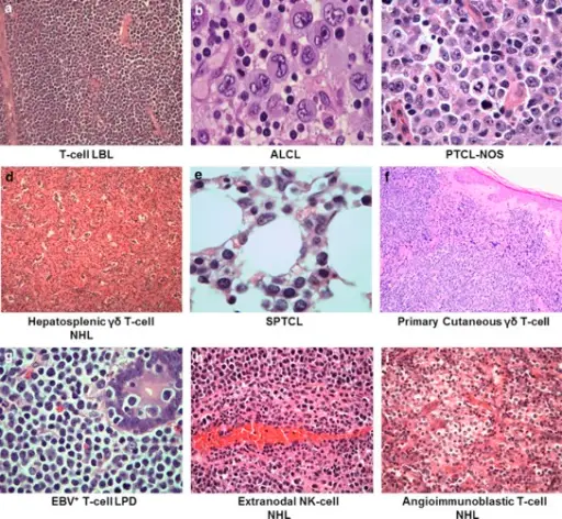 Peripheral T-Cell Neoplasms_Histology