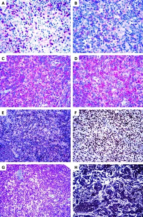 Peripheral T-Cell Neoplasms_Peripheral T-Cell Lymphoma NOS_Histology