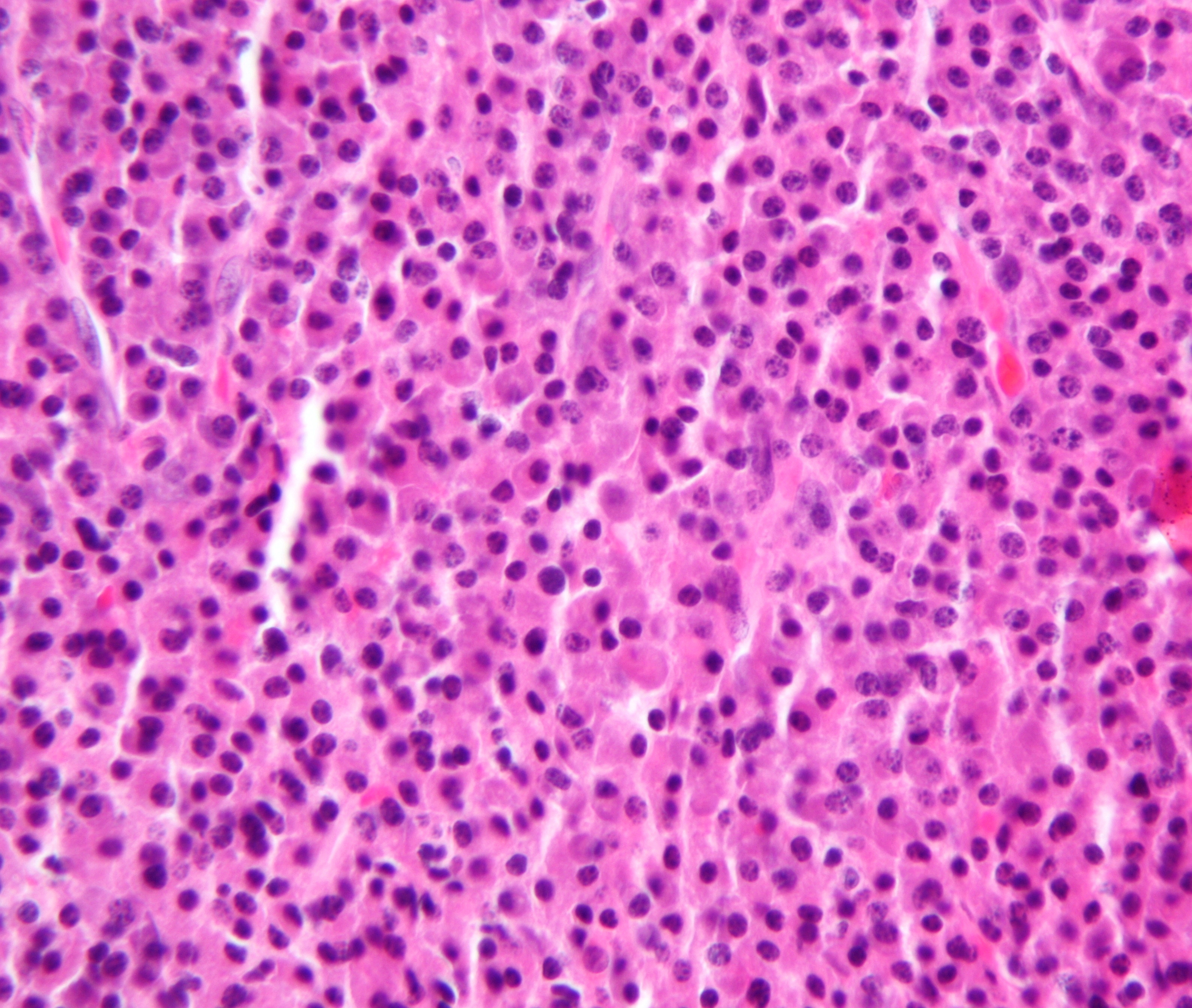 Plasmacytoma_Histology_H&E