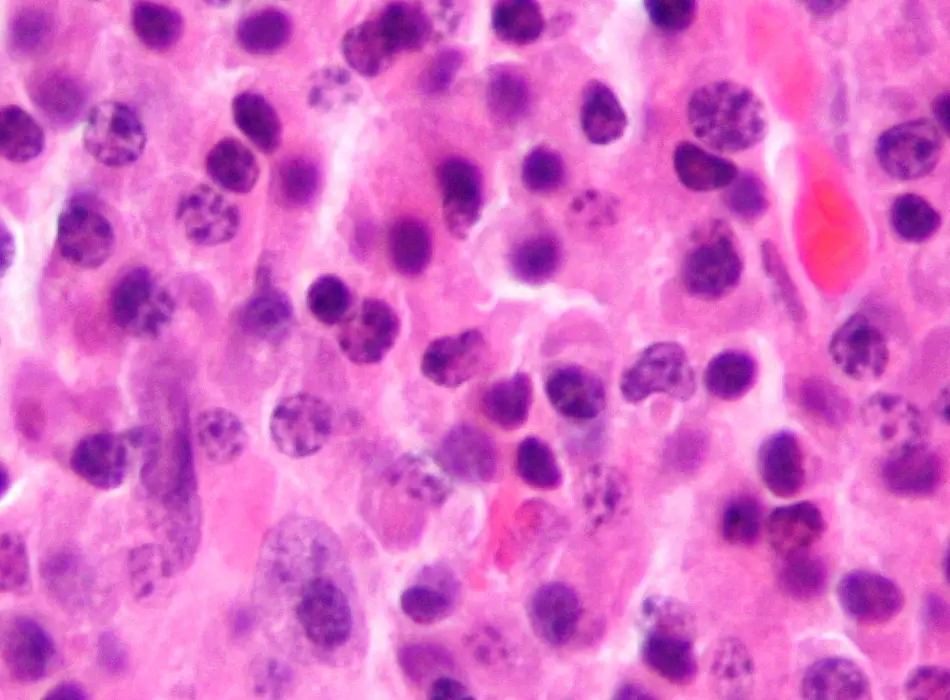 Plasmacytoma_Histology