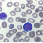 Precursor B-Cell Neoplasms