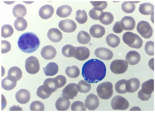 Precursor B-Cell Neoplasms