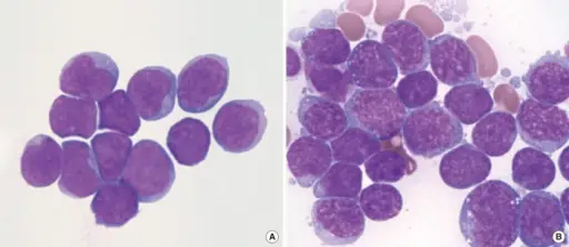 Precursor B-Cell Neoplasms