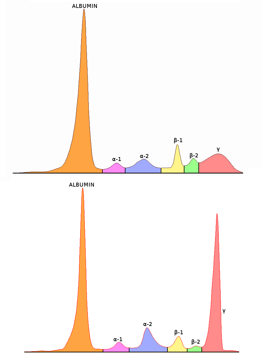 Plasmacytoma_Serum_protein_electrophoresis_normal_and_paraprotein