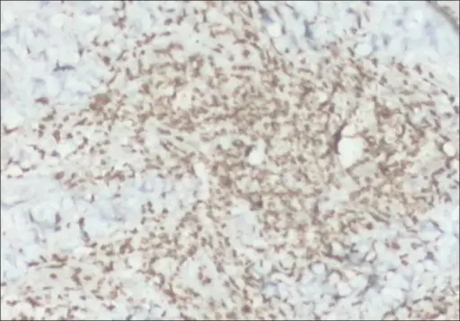 T-Cell Prolymphocytic Leukemia_CD3 IHC