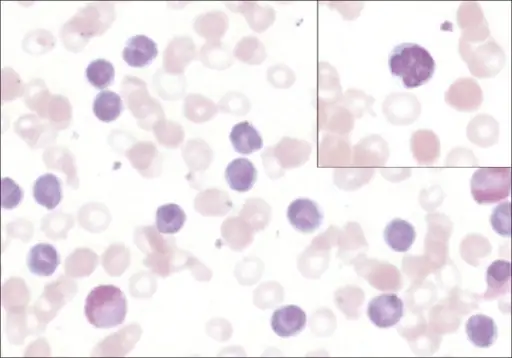 T-Cell Prolymphocytic Leukemia_Flow Cytometry_Peripheral Blood Smear