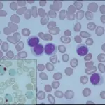 T-Cell Prolymphocytic Leukemia_Histology