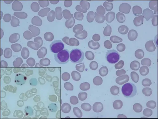 T-Cell Prolymphocytic Leukemia_Histology