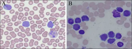 T-Cell Prolymphocytic Leukemia_Histology