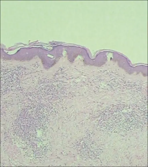 T-Cell Prolymphocytic Leukemia_Skin Involvement