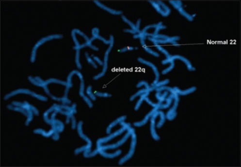 22q11.2 Deletion Syndrome