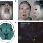 22q11.2 deletion syndrome