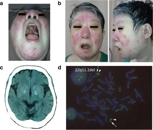 22q11.2 deletion syndrome