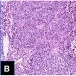 A THYMIC CARCINOMA