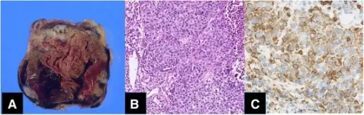 A THYMIC CARCINOMA