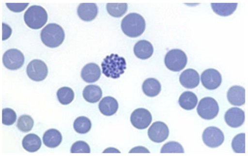 A Thalassemia