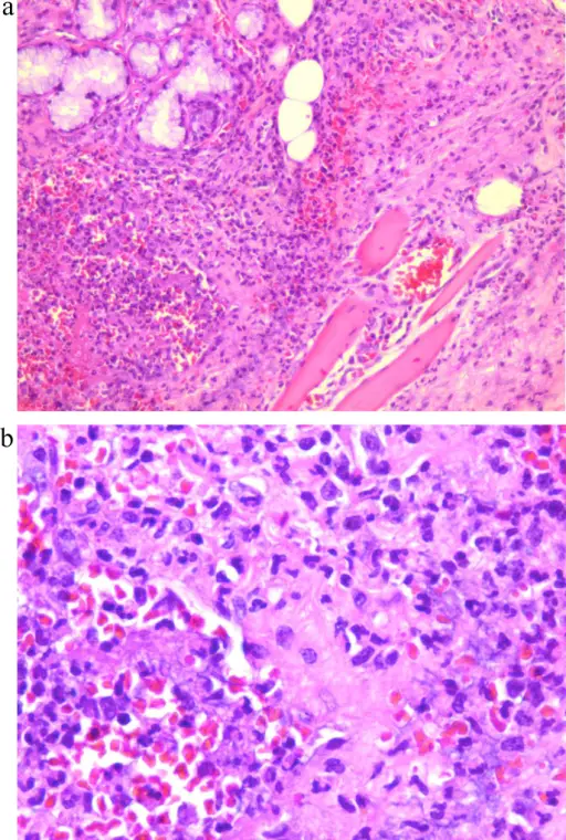 ACUTE INFLAMMATION