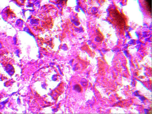 ADRENAL GLAND PATHOLOGY