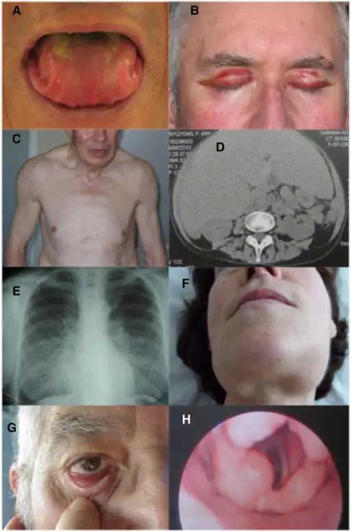 AL Amyloidosis