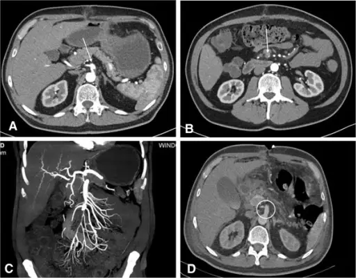 AN EMBOLISM