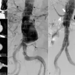 Abdominal Aortic Aneurysm