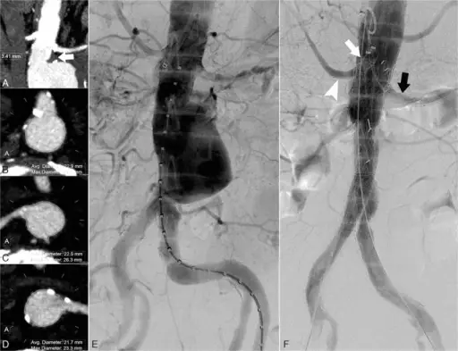 Abdominal Aortic Aneurysm