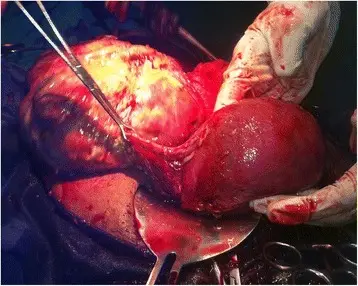 Abnormalities of Placental Implantation