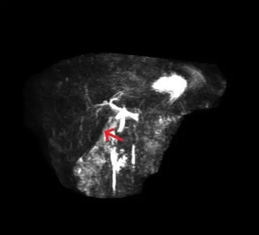 Absent Gallbladder