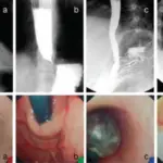 Achalasia