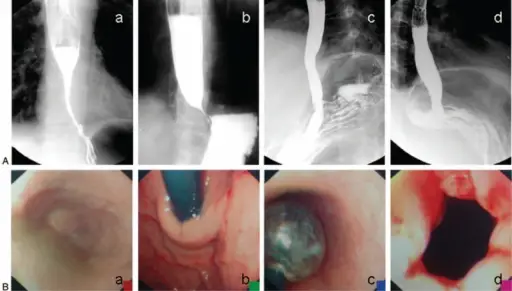 Achalasia