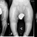 Achondroplasia