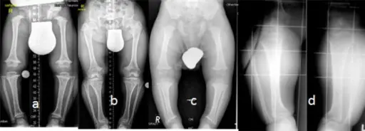 Achondroplasia