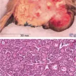 Acinar Cell Carcinoma