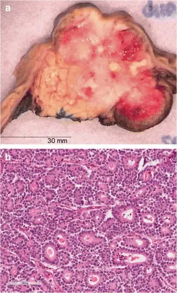 Acinar Cell Carcinoma