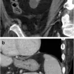 Acquired (Dialysis-Associated) Cystic Disease