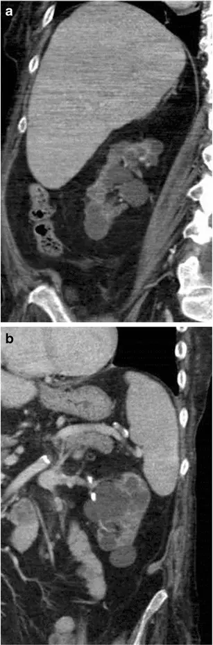 Acquired (Dialysis-Associated) Cystic Disease