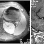 Acromegaly