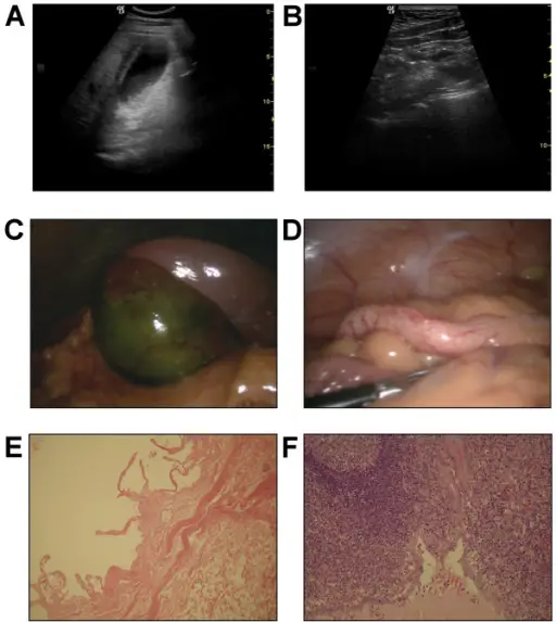 Acute Appendicitis