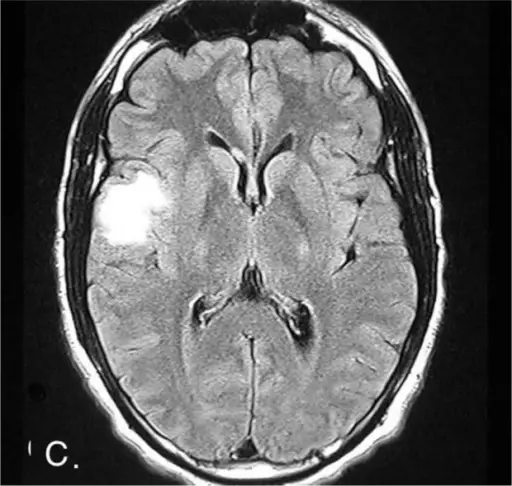 Acute Disseminated Encephalomyelitis